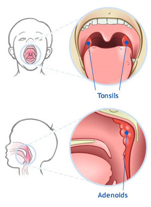 pic-tonsil-adenoids
